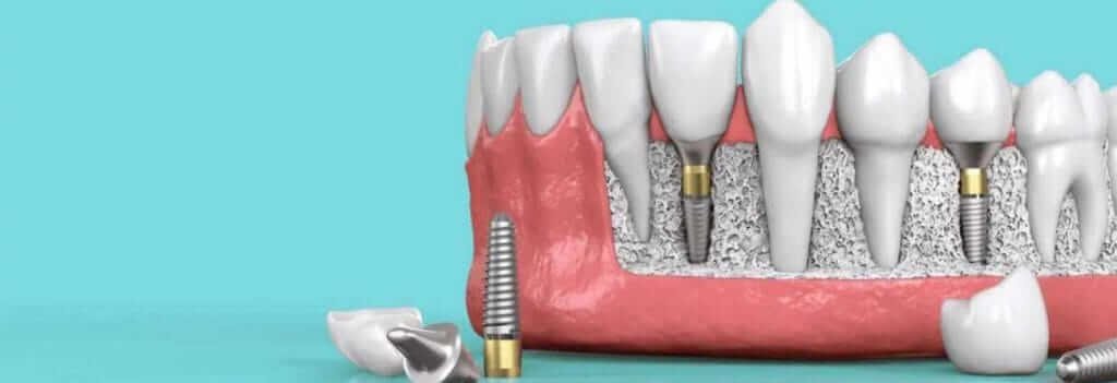 Benefits of Implant Supported Dentures