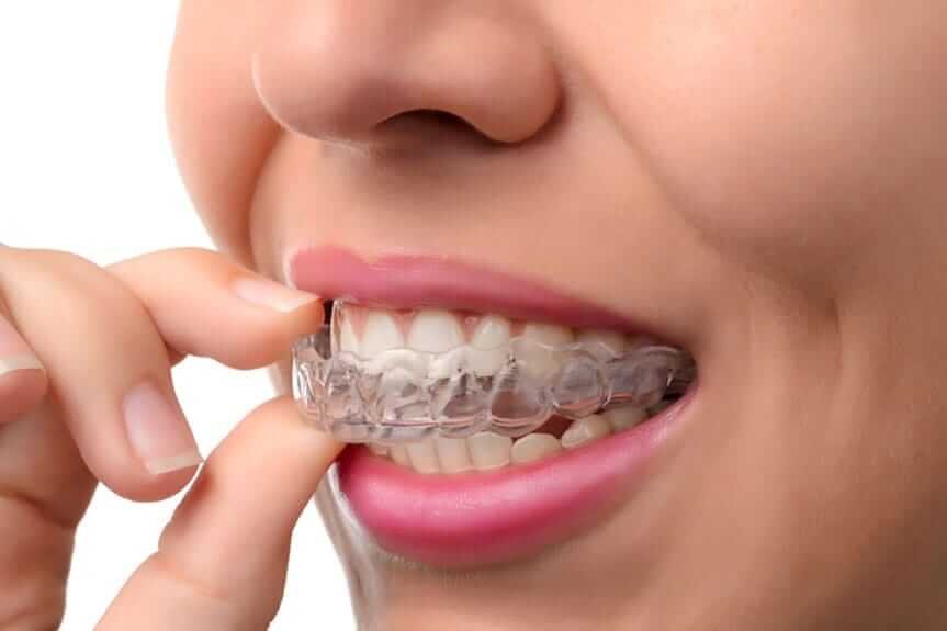 Benefits of wearing Invisible Braces
