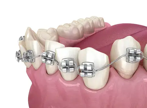 Problems Associated with Braces