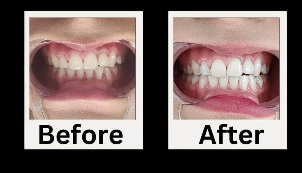 tooth whitening treatment results