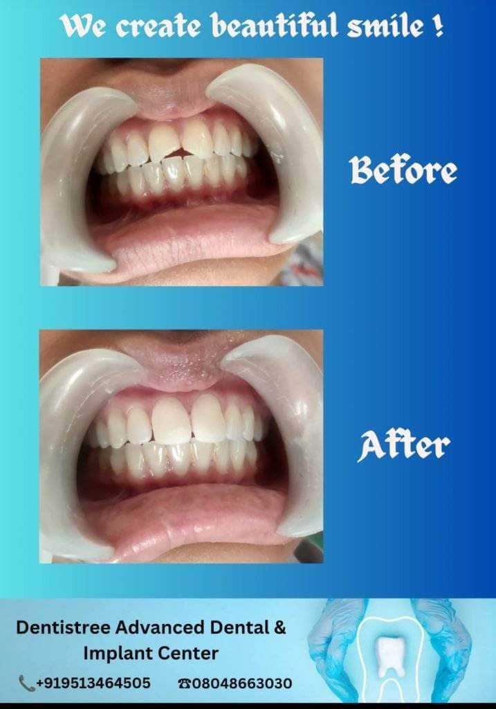Before and after image of dental veneers treatment at Dentistree Advanced Dental & Implant Center, Bengaluru.