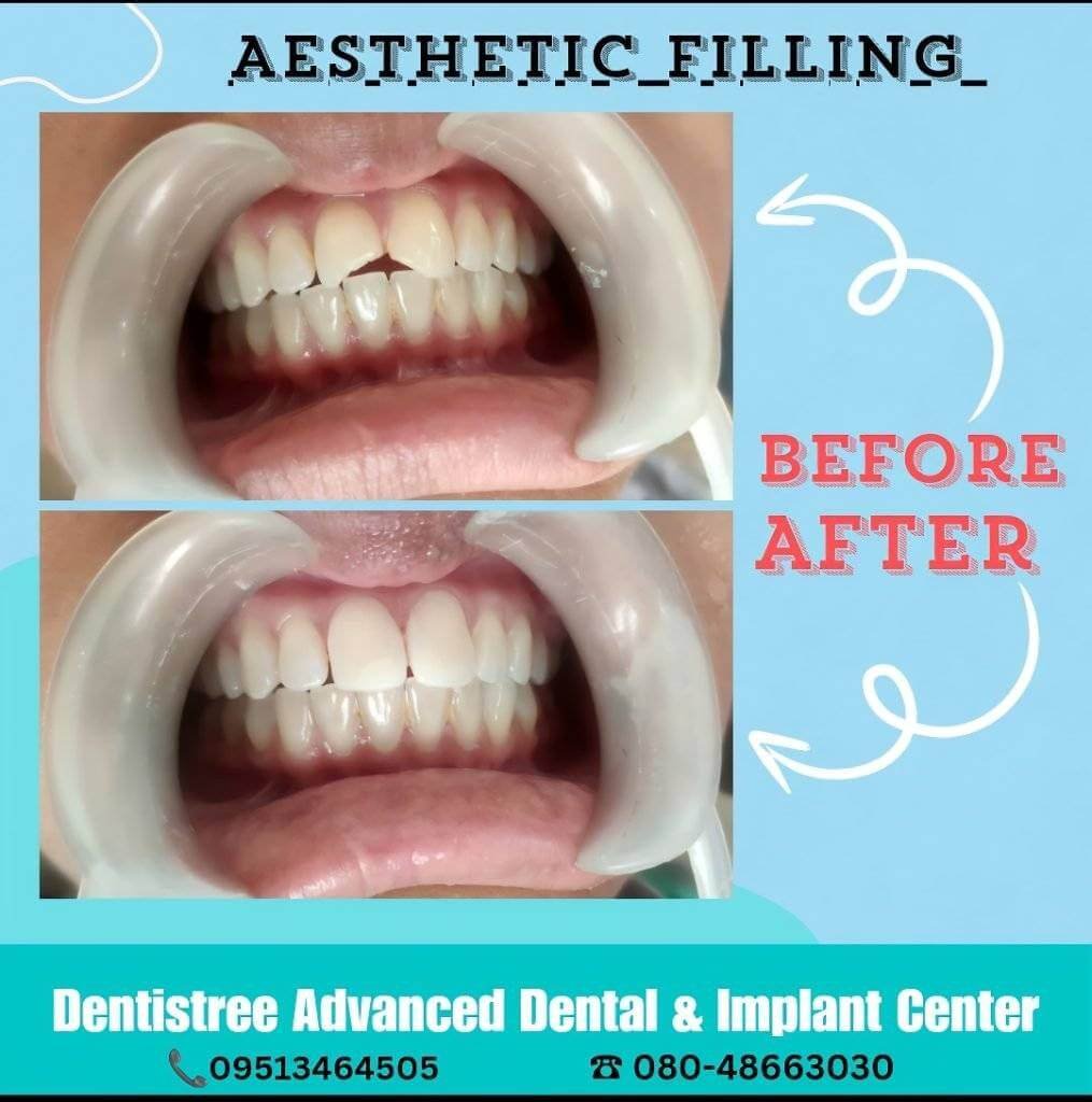 Before and after aesthetic filling treatment