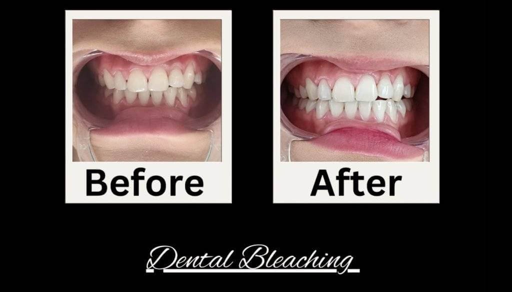 Before and after dental bleaching treatment at Dentistree Advanced Dental & Implant Center