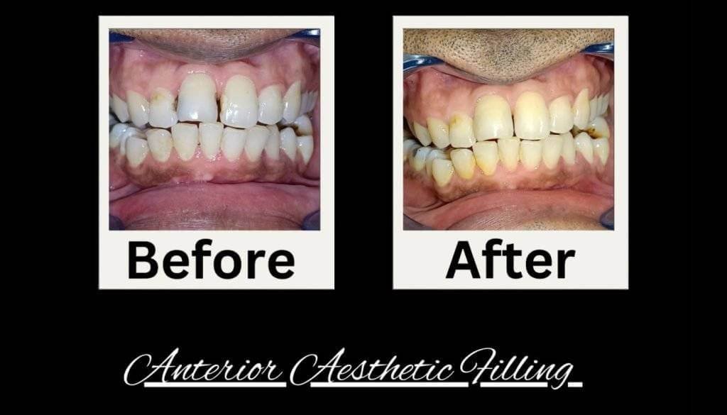 Before and after teeth whitening treatment at Dentistree