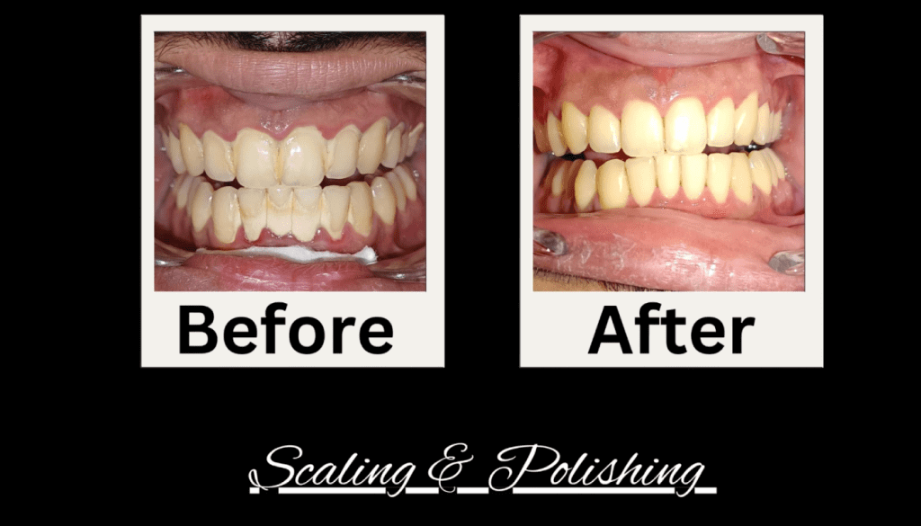 Adult scaling and polishing treatment