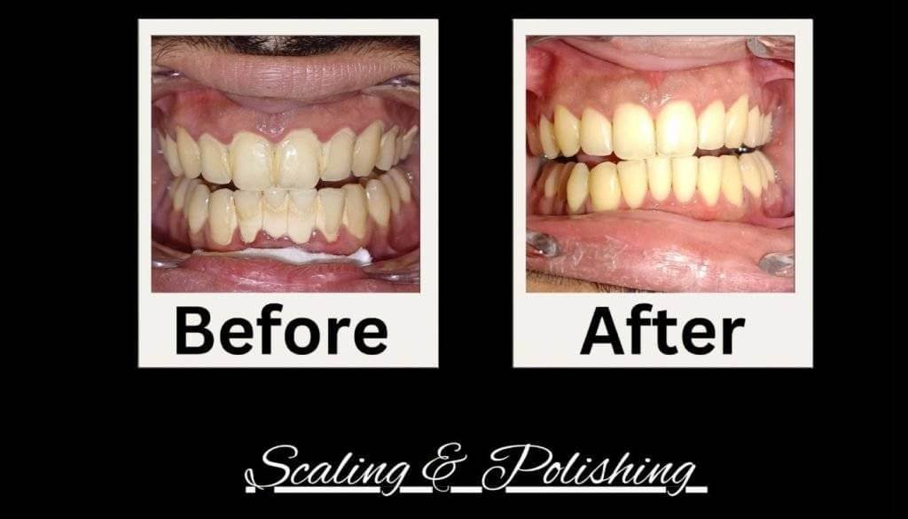 Before and after scaling and polishing treatment