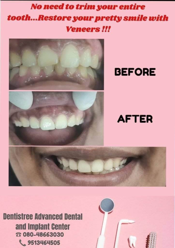 Before and after veneer treatment at Dentistree Arekere Bangalore