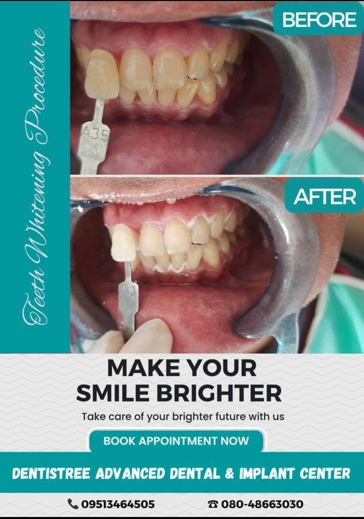 Before and after teeth whitening procedure