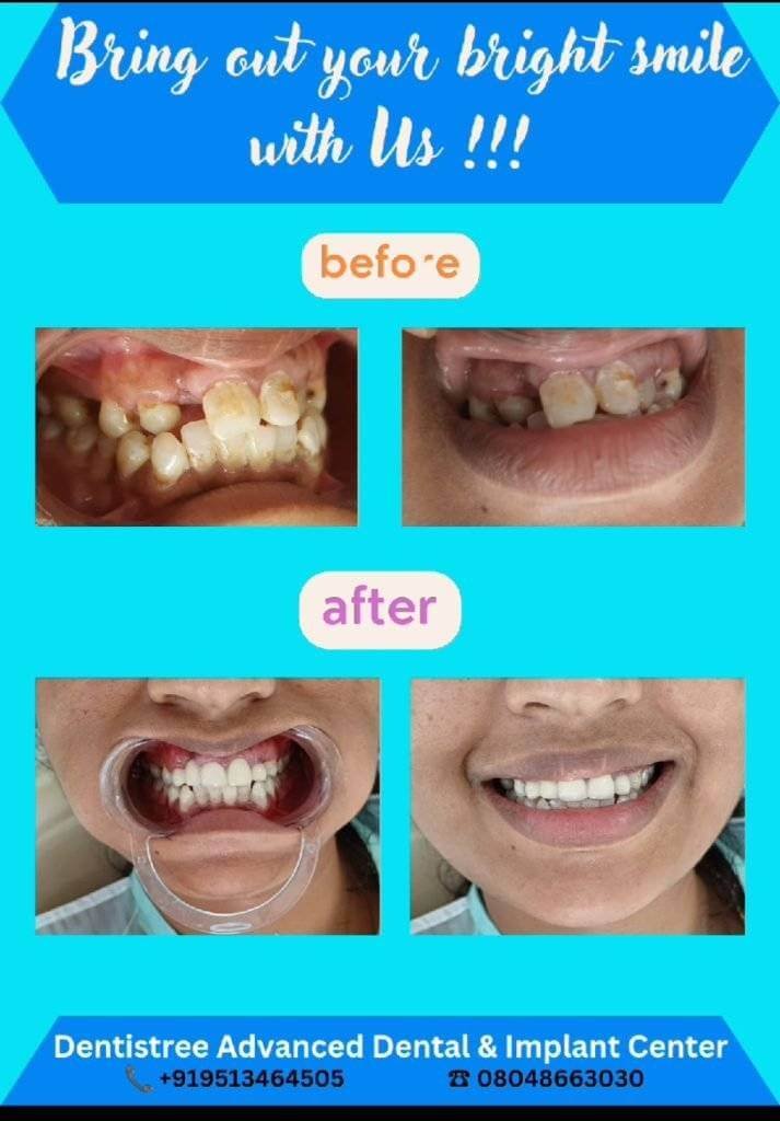 Before and after teeth whitening treatment