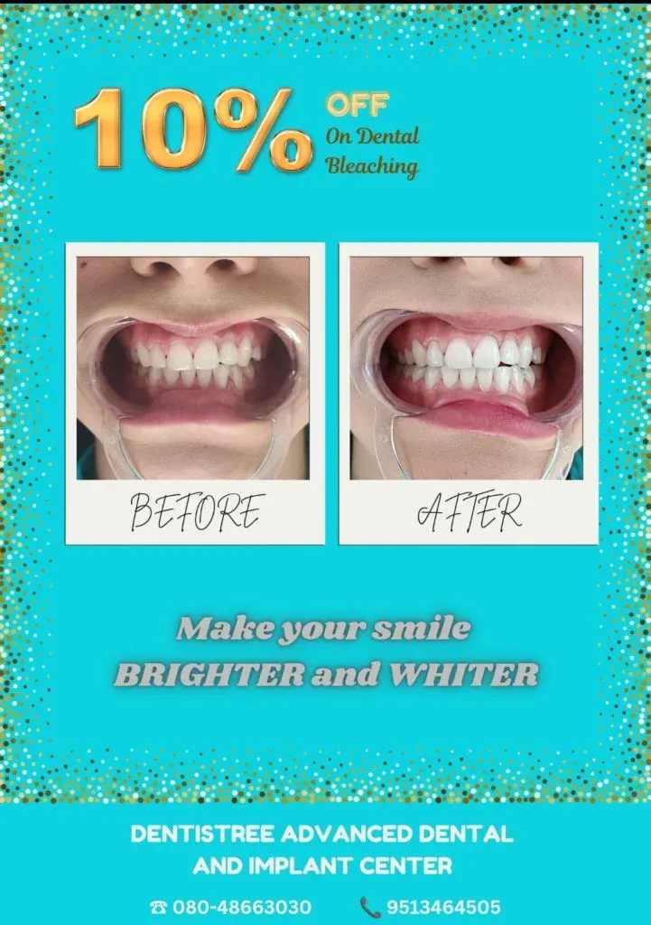 Before and after result of dental bleaching