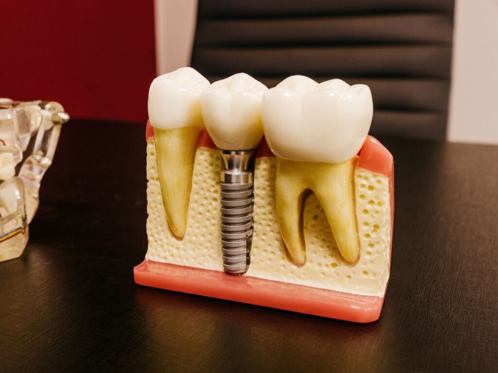 Dental Implant Surgery Aftercare | Post-Operative Recovery Guide