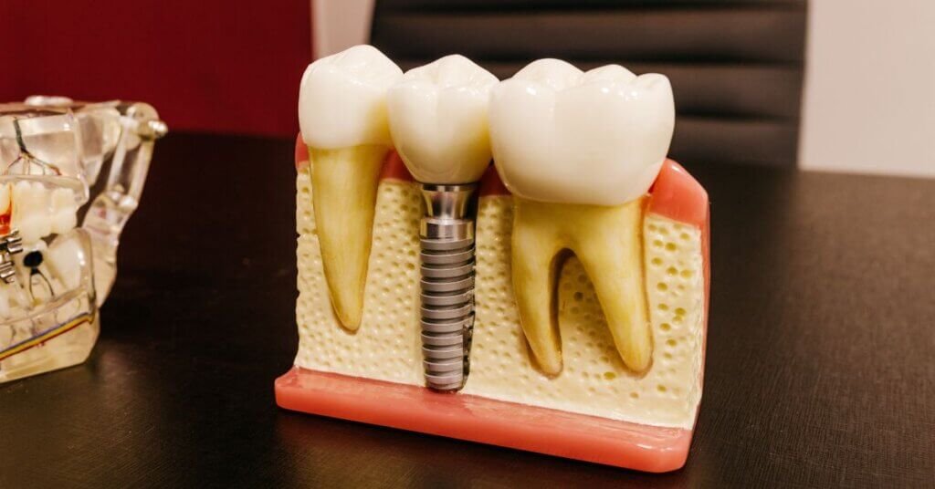 How Do Dental Crowns Restore Damaged Teeth?