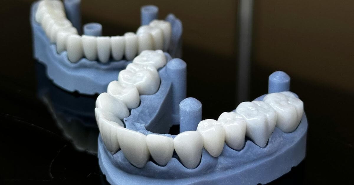 Dental Crowns and Bridges