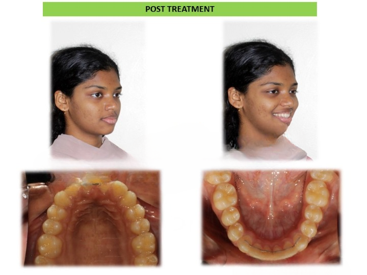 Before and after Invisalign clear aligners teeth alignment treatment at Dentistree Advanced Dental & Implant Center in Arekere, Bangalore