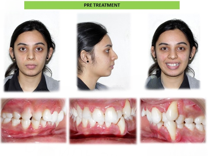 Pre and post comparison of Invisalign