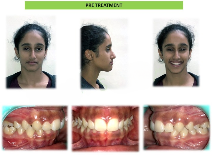 Clear Aligners Pre and post comparison