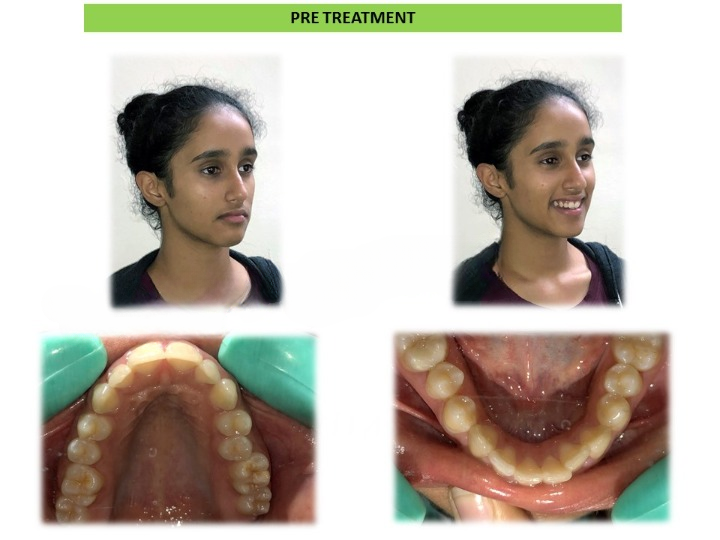 Before and after cosmetic dental correction results in Arekere