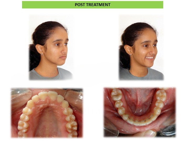 Aligner treatment results showing teeth straightening in Arekere