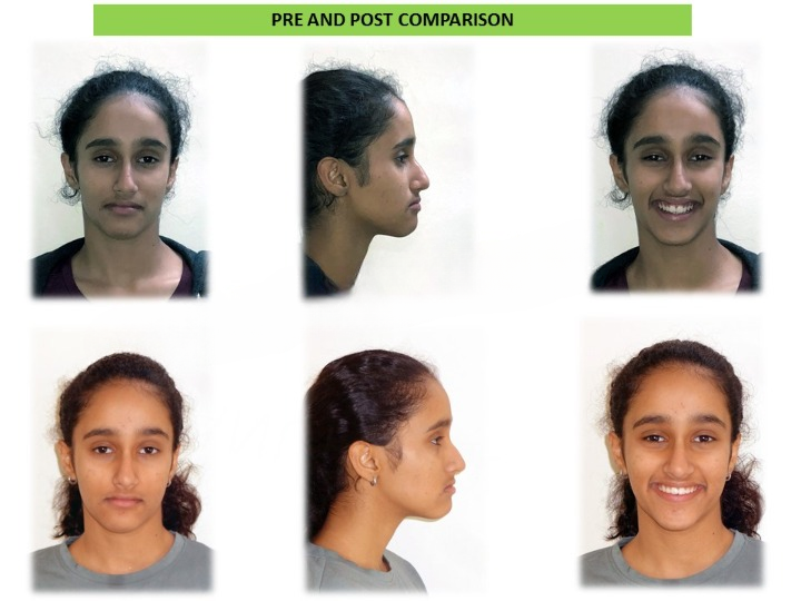 Pre and post comparison of dental treatment at Dentistree Advanced Dental & Implant Center