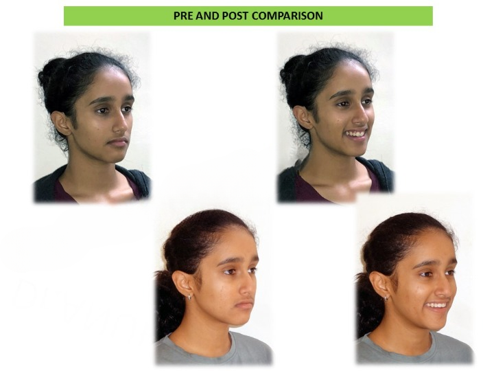 Before and after comparison of clear teeth aligners