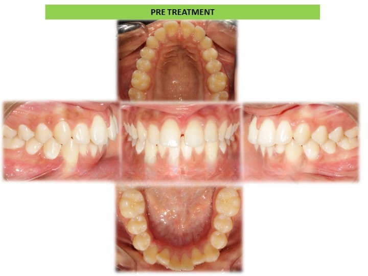 Before and after teeth alignment treatment using Invisalign clear aligners at Dentistree Advanced Dental & Implant Center in Arekere, Bangalore, showing upper, lower, and front views.