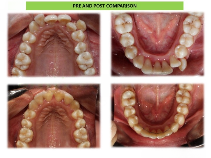 Before and after braces treatment at Dentistree Advanced