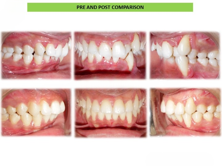 Before and after teeth alignment results in Arekere