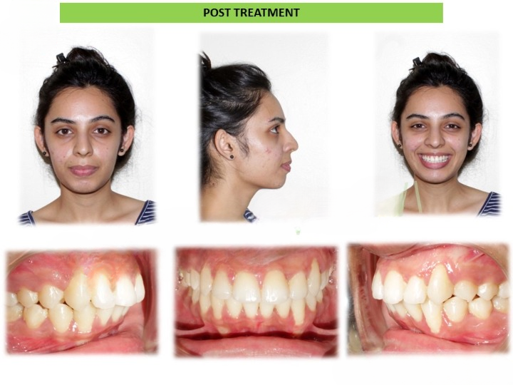 Pre and post comparison of teeth alignment results in Arekere