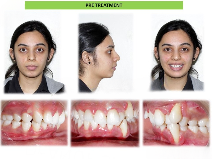 Cosmetic dental correction for enhanced smile in Arekere
