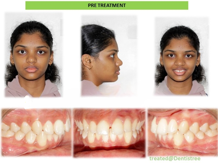 Teeth alignment and correction treatment in Arekere