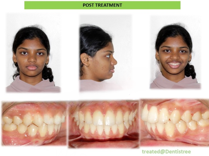 teeth alignment and cosmetic correction