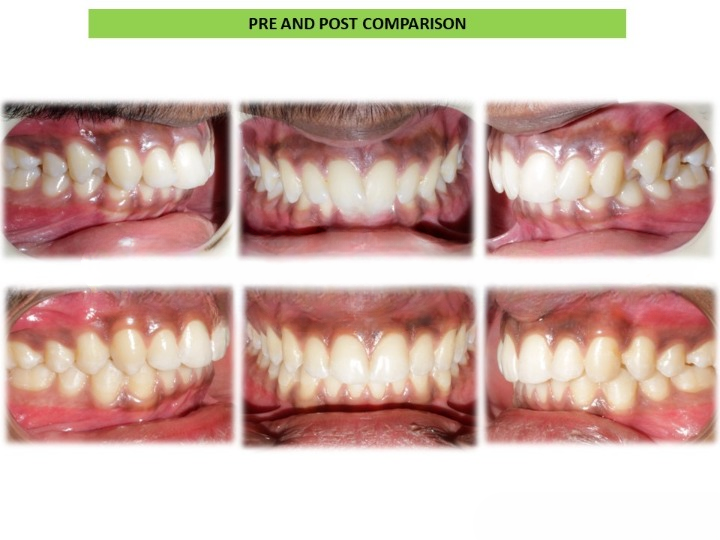 Before and after teeth whitening treatment at Dentistree Advanced Dental & Implant Center in Arekere Bangalore